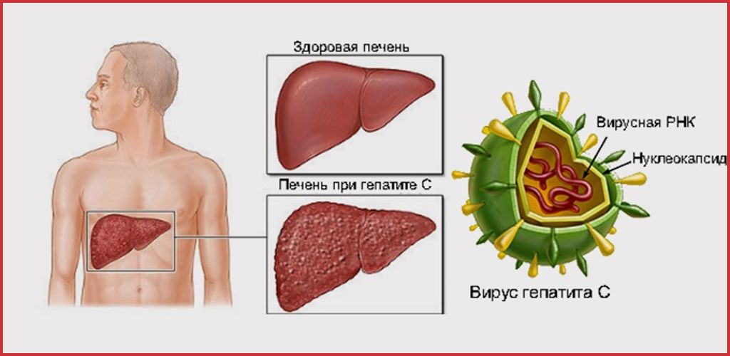 Острый вирусный гепатит С и меры профилактики.