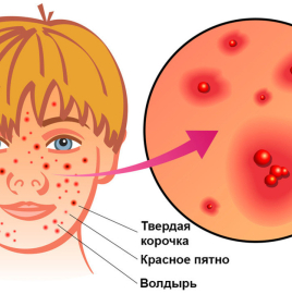 Профилактика ветряной оспы
