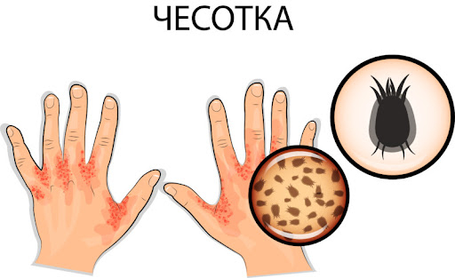 Профилактика чесотки
