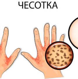 Профилактика чесотки
