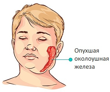 Эпидемический паротит