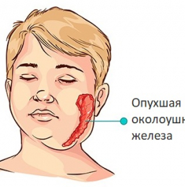 Эпидемический паротит